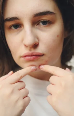 kenapa jerawat tidak kunjung hilang